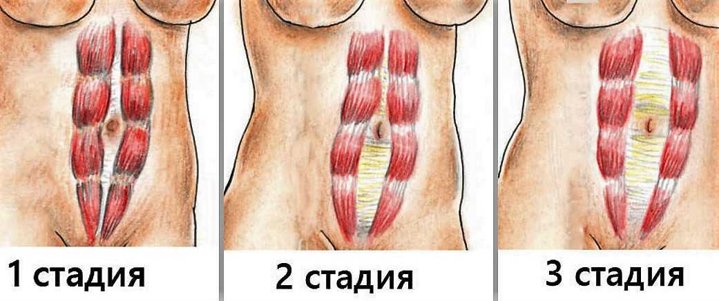 Йога при диастазе