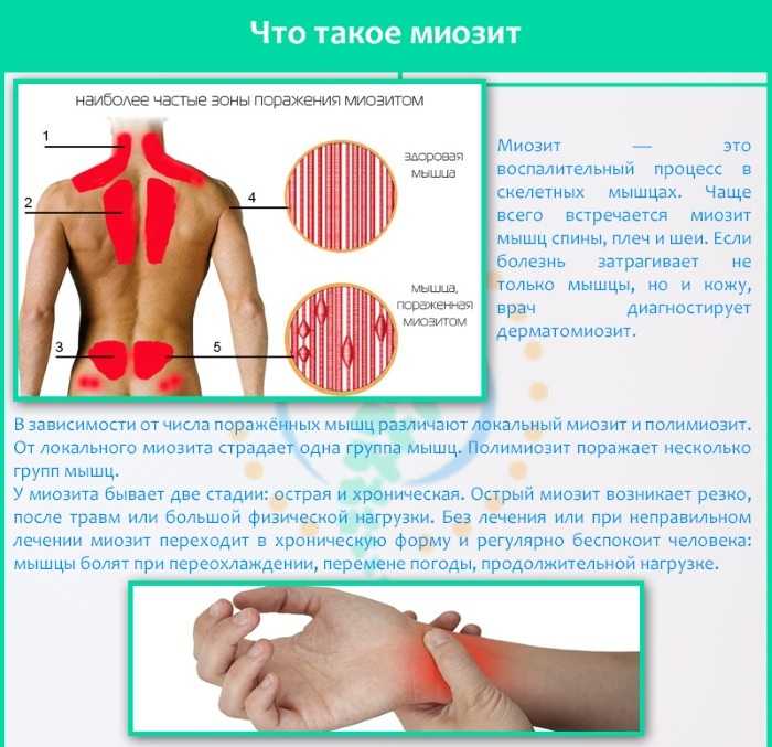 Заболела поясница после тренировки? – срочно сделайте это!!!