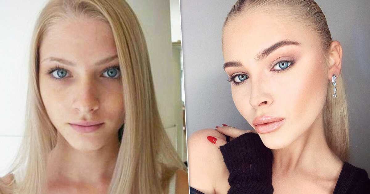 Больше не куколка: что с лицом алены шишковой?