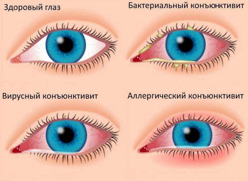 Воспаление глаз от спермы