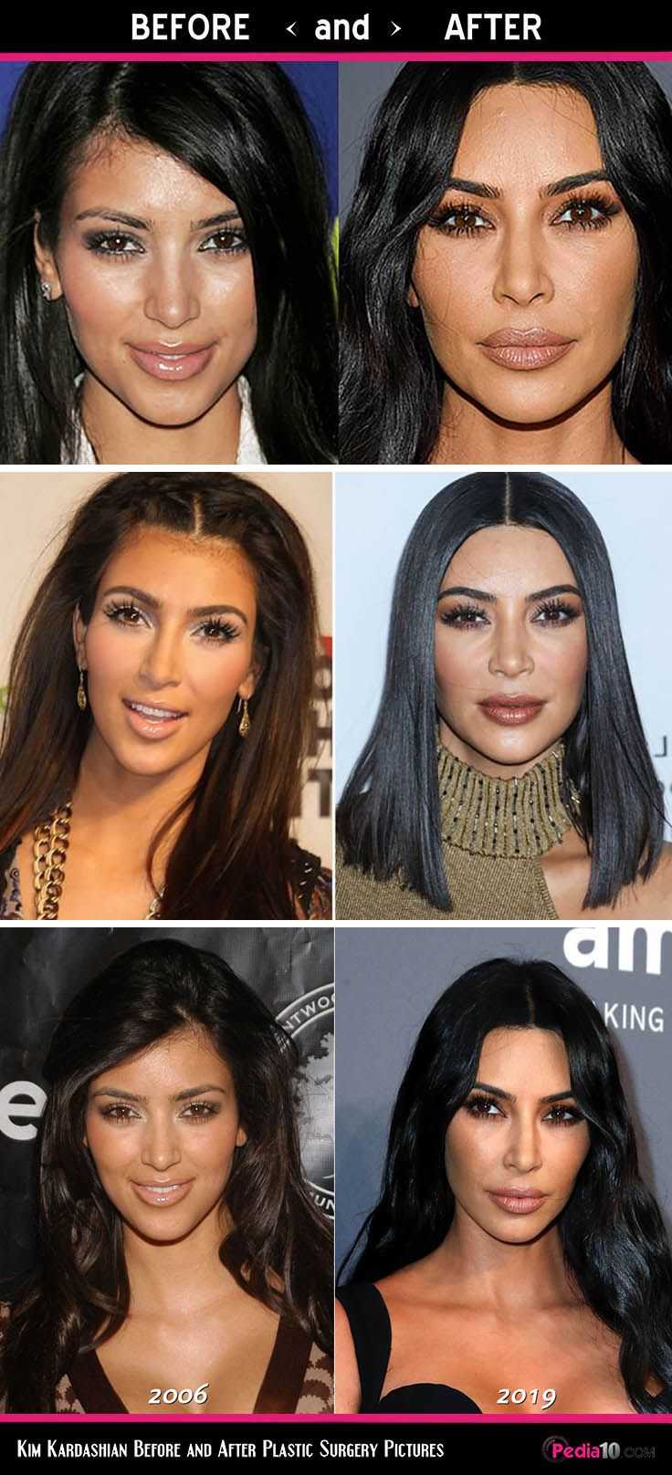 Kim kardashian plastic surgery revealed! (before & after pics 2018)