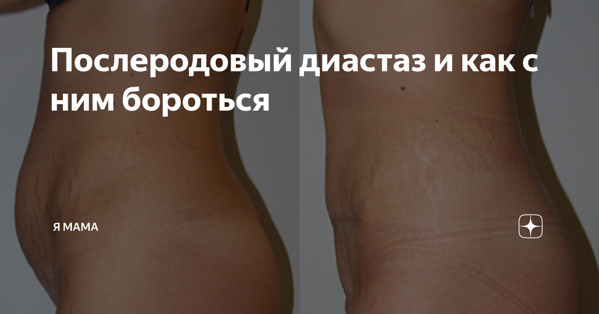 Упражнения при диастазе прямых мышц живота