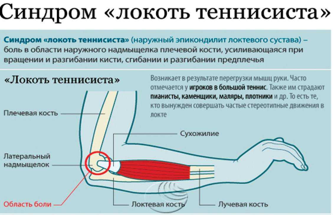 Болят локти после тренировки: причины и лечебные меры