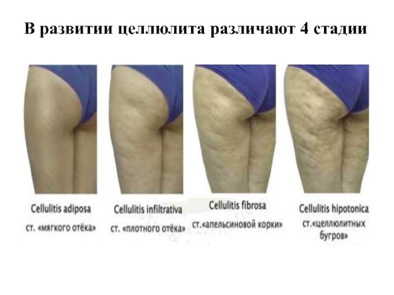 Как избавиться от целлюлита за месяц — тренировки упражнения против апельсиновой корки на ногах