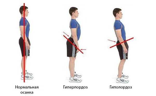 Упражнения и массаж при поясничном лордозе. как избавиться от лордоза поясничного отдела?