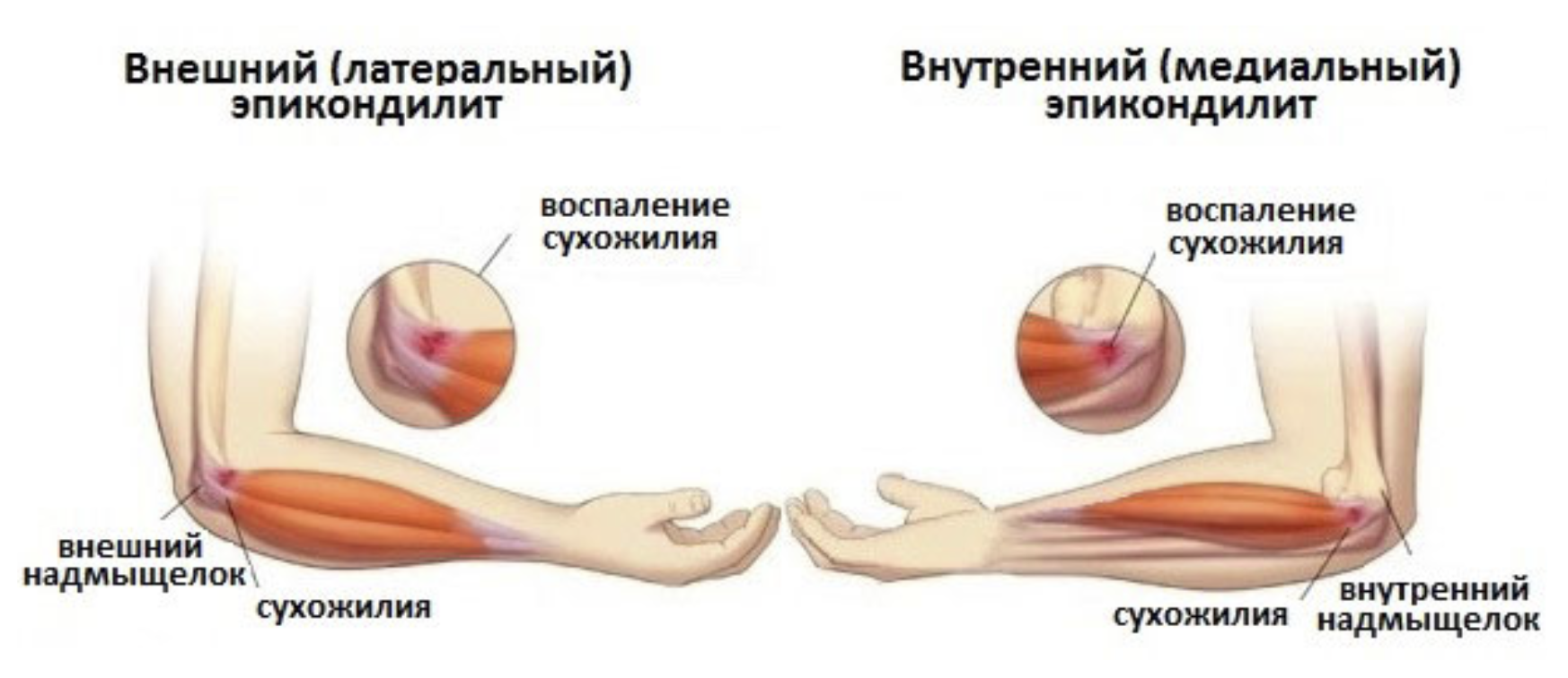 Какие бывают симптомы и причины болей в локтях после тренировки Почему и что делать при болях в локтях при нагрузке Эти симптомы часто встречаются у пациентов активно занимающихся спортом
