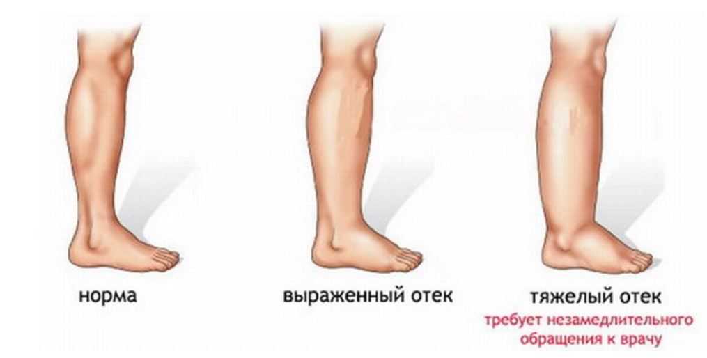 Отекают ног. причины. лечение | центр флебологии нмхц пирогова