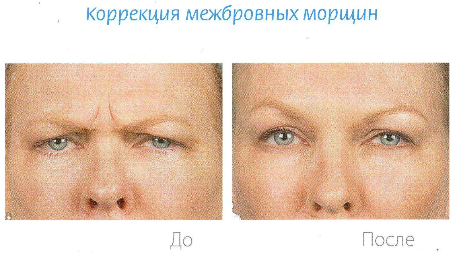 Вместо ботокса: техника, которая разгладит межбровную морщину