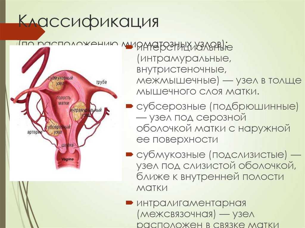 Можно ли женщине качать пресс при миоме матки?
