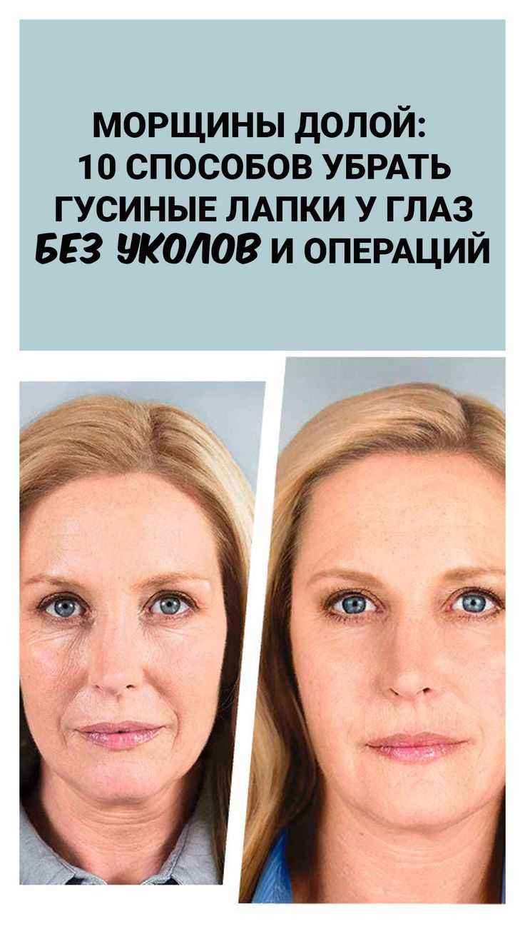7 способов быстро избавиться от гусиных лапок вокруг глаз и на лице - журнал womanem