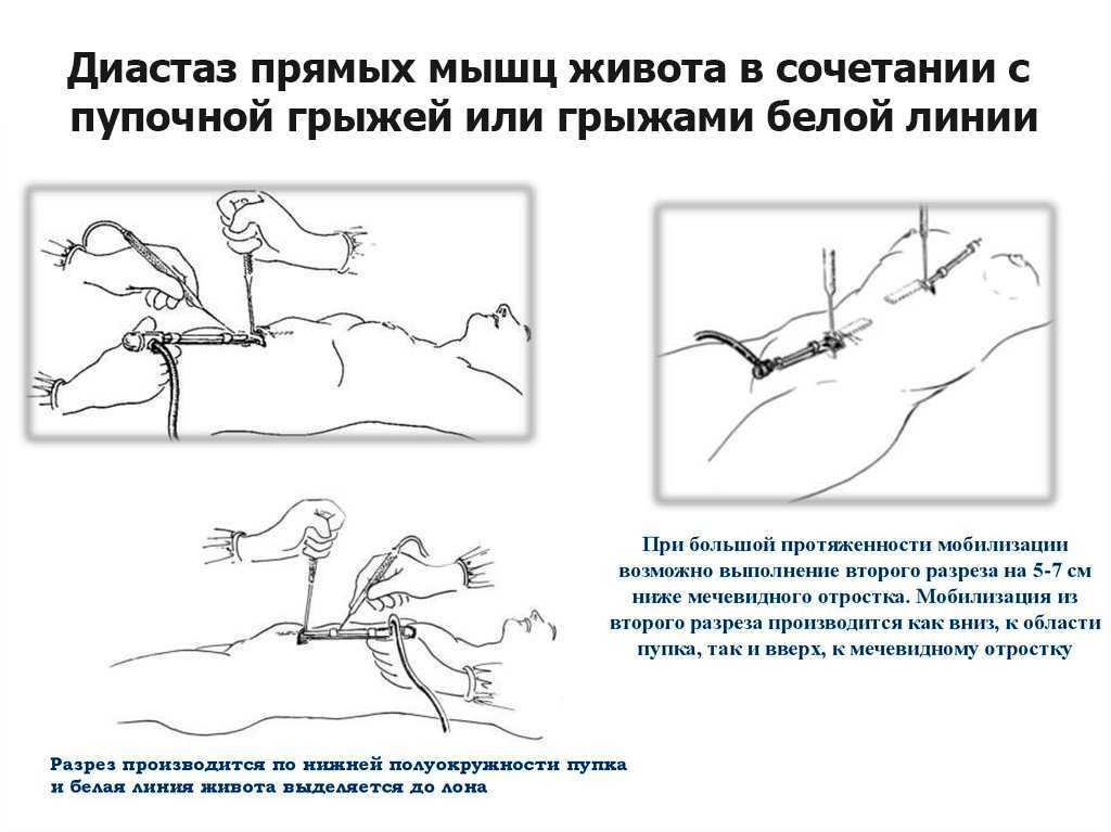 Диастаз прямых мышц живота: упражнения для женщин и мужчин