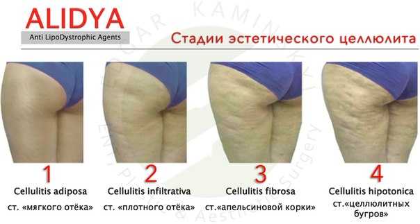 Как избавиться от целлюлита - как убрать целлюлит быстро
