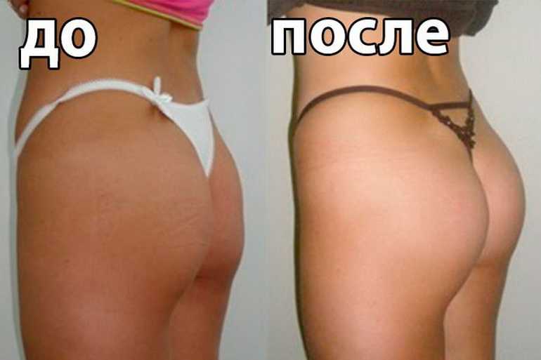 Самая неудачная пластика ягодиц у звезд