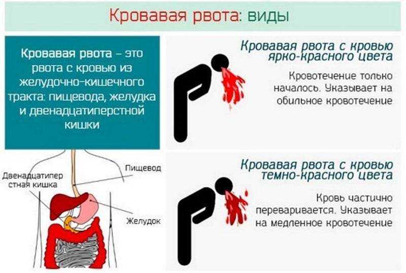Тошнота, рвота и головокружение во время тренировки – причины и способы устранения
