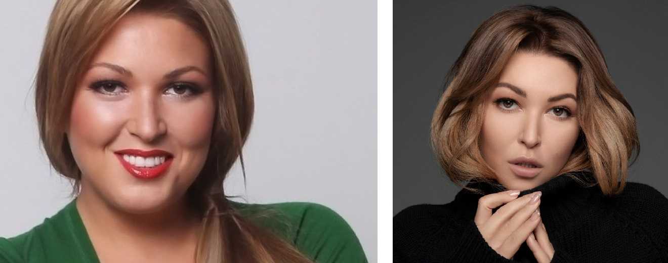 Ирина дубцова уменьшила грудь