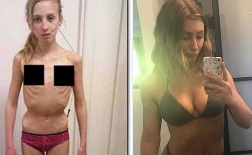 Юлия савичева поведала, как смогла победить анорексию -