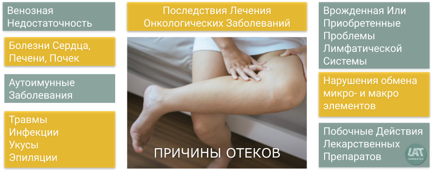 Как избежать отечности ног